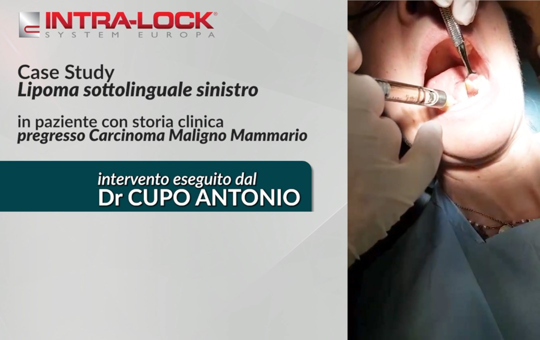 Neoformazione Benigna Lipoma sottolinguale sinistro eseguito dal Dr Antonio Cupo